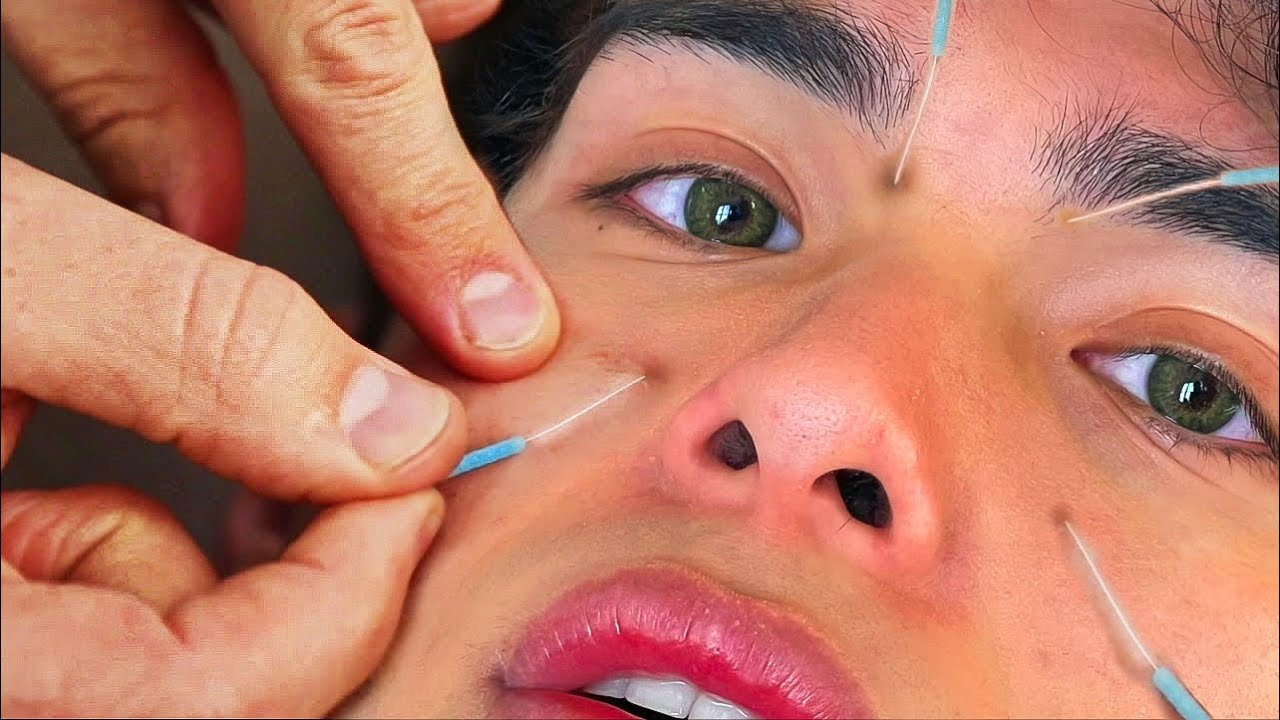 Trying Acupuncture For The First Time…