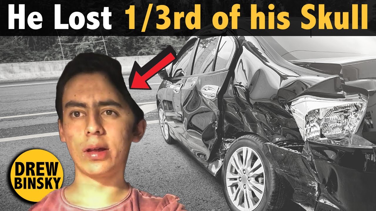 How He Lost 1/3rd of His Skull (Inspiring Story)