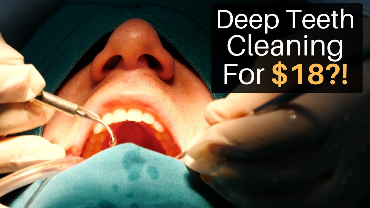 A Deep Teeth Cleaning for $18?!